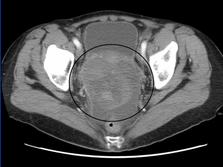 Combatiendo El Cáncer: Cáncer De Ovario