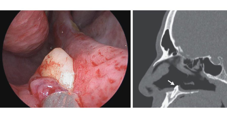 Médicos descubren un diente creciendo dentro de la nariz de un paciente